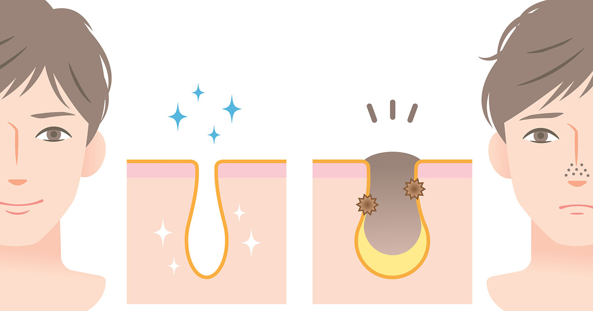 毛穴汚れを落とす方法は洗顔 毛穴パック 選び方の解説 Dorekau ドレカウ