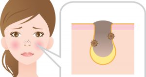 毛穴に黒ずみができる原因って？予防法と対策に効果的な品を解説