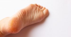 かかとがガサガサになる原因って？おすすめのかかと角質ケアグッズ